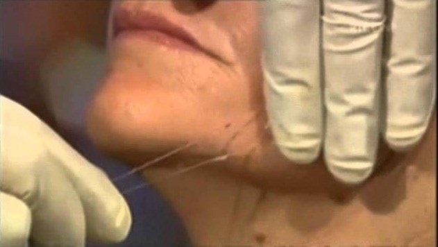 سحب الخيوط وشدّها بعد إدخالها تحت طبقة الجلد الخارجية سحب الخيوط وشدّها بعد إدخالها تحت طبقة الجلد الخارجية