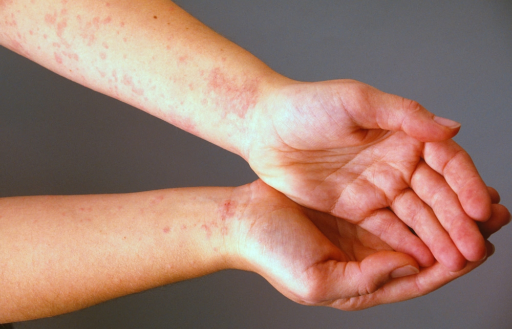 الميادين ما هي حساسية الجلد وكيف نتوقاها