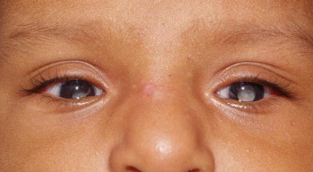 ما دور فلاش الصورة انتبه لسرطان العيون الميادين